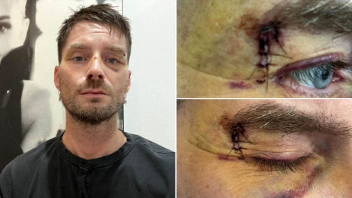 Luca Burini aggredito a Milano: “Pestato senza motivo, si sono fermati solo quando hanno visto il sangue”
